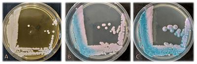 Candida palmioleophila candidemia and bacterial co-infection in a 3-month-old infant with biliary atresia